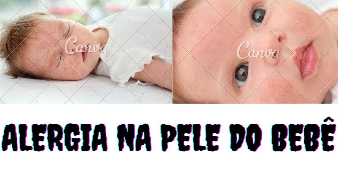 Alergia na pele do bebê