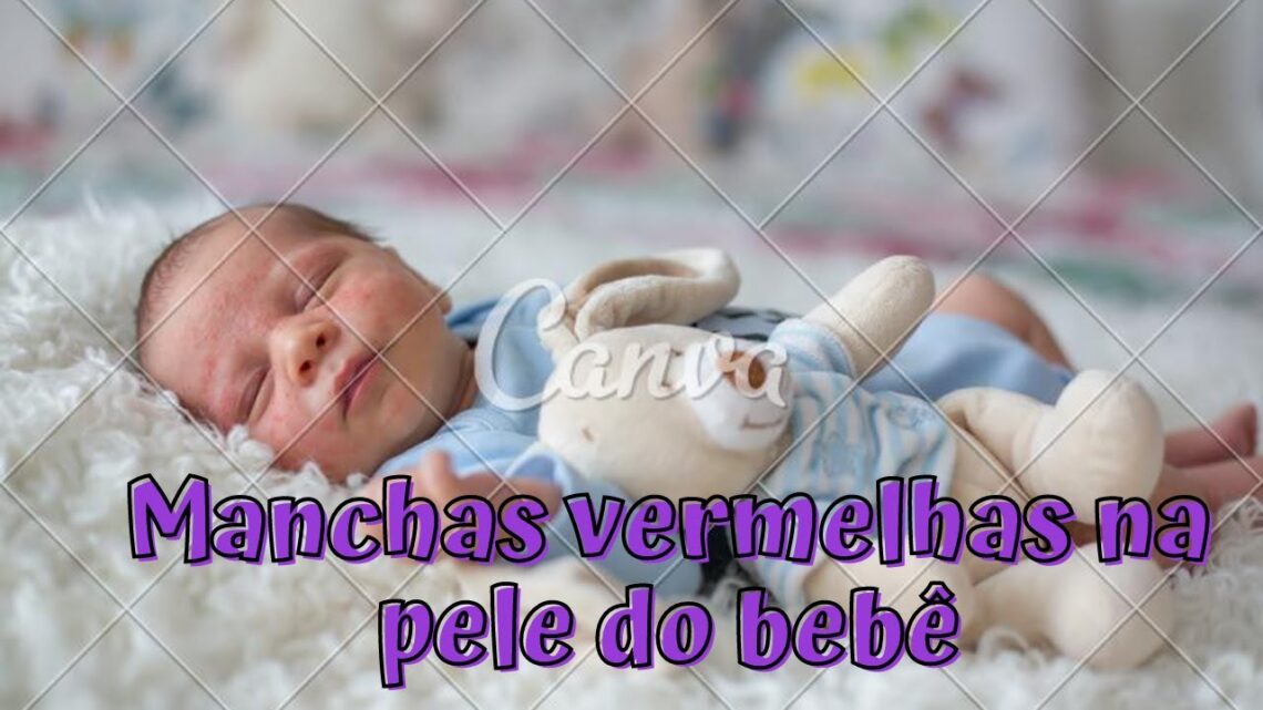 Manchas vermelhas na pele do bebê