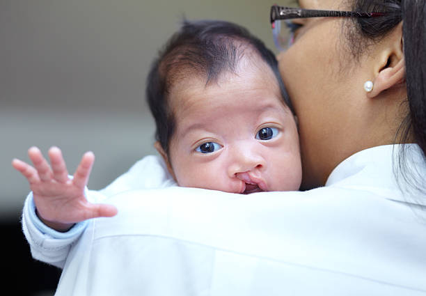 Como amamentar bebês com fissuras?